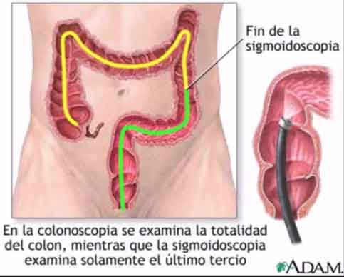 Colonoscopia procedimiento