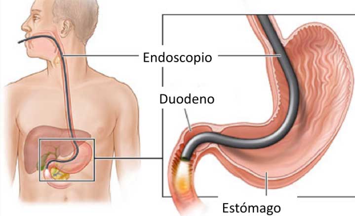 Gastroscopia GOODMAN