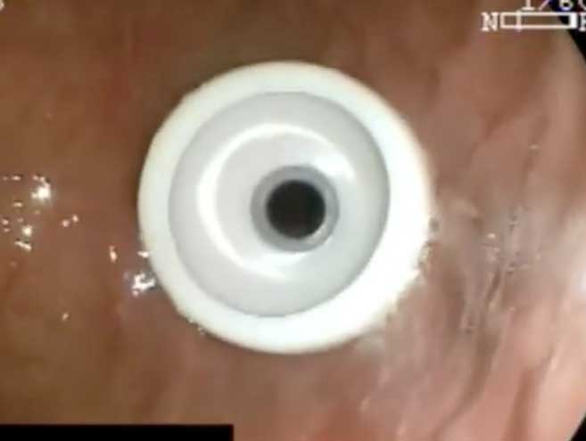 Vista endoscópica de la sonda de gastrostomía