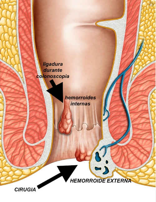 Ligadura de hemorroides — imagen 3