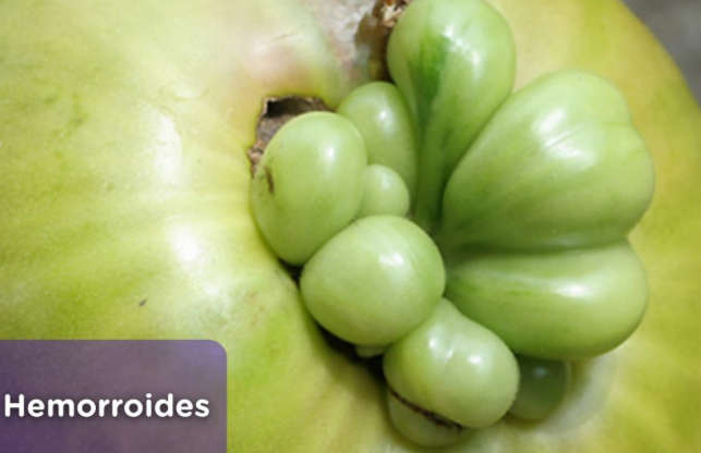 Ligadura de hemorroides — imagen 4