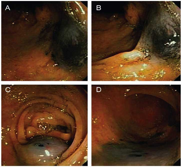Tatuaje de tumores GOODMAN
